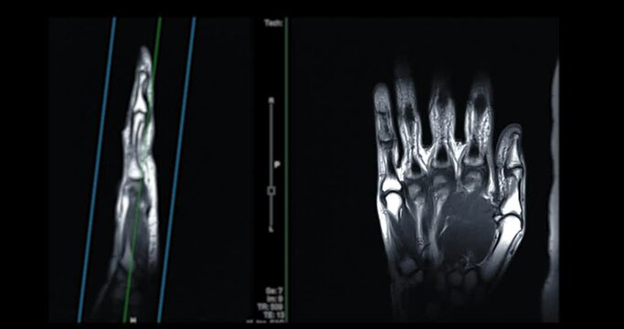 MRI hand  for diagnosis bone arthritis and rheumatoid.