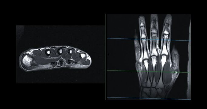 MRI hand  for diagnosis bone arthritis and rheumatoid.