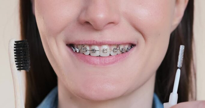Beautiful female smile in dental braces, with orthodontic toothbrushes, close-up. Metal braces cleaning, dentistry hygiene care concept. Cropped white teeth smiling, brushing self-ligating brackets
