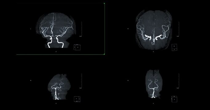 MRA Brain or Magnetic resonance angiography of Cerebral artery turn around on the screen. MRA Brain MIP view for evaluate cerebral artery.
