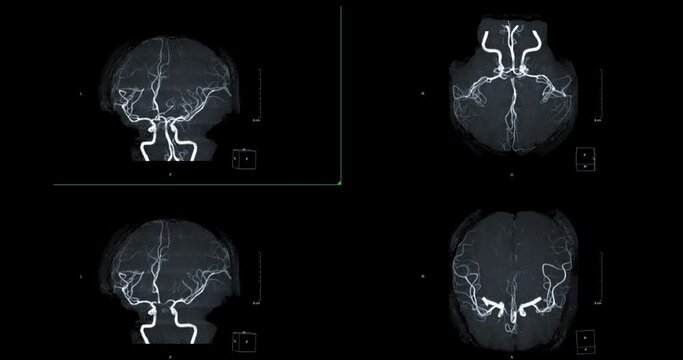 MRA Brain or Magnetic resonance angiography of Cerebral artery turn around on the screen. MRA Brain MIP view for evaluate cerebral artery.
