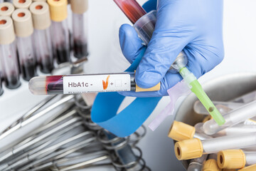 Blood sample for HbA1c test, diabetes diagnosis.