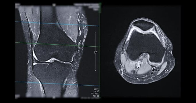 MRI knee or Magnetic resonance imaging of knee joint   for detect acl ligament tear.