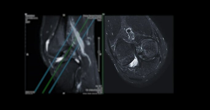 MRI knee or Magnetic resonance imaging of knee joint   for detect acl ligament tear.