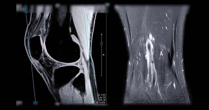 MRI knee or Magnetic resonance imaging of knee joint   for detect acl ligament tear.