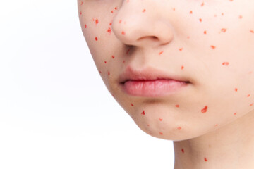 cheerful woman with bare shoulders dermatology pimples