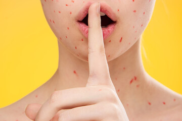 female face closeup red dots dermatology rash