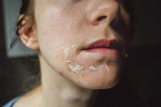 Woman's face after chemical peeling. Peeling skin on the face. Exfoliation of old skin problems, acne, blackheads.