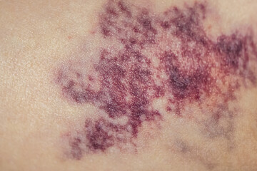 Hematoma wound on human skin