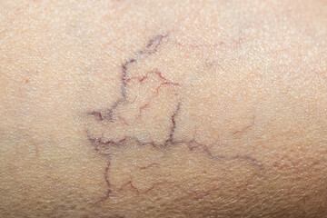Blood vessels on human skin