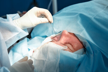 Fototapeta premium Close up of the face of a patient who is undergoing blepharoplasty. The surgeon cuts the eyelid and performs manipulations using medical instruments
