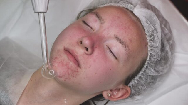 Darsonvalization of the face in a young girl with problem skin.