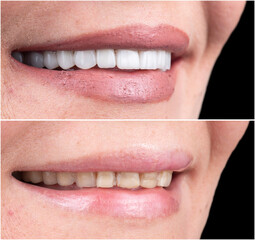 teeth indirect restoration and making new smile by ceramic veneers b1 color