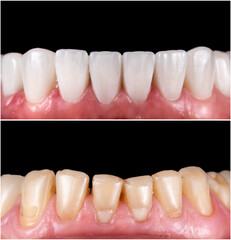 teeth indirect restoration and making new smile by ceramic veneers b1 color