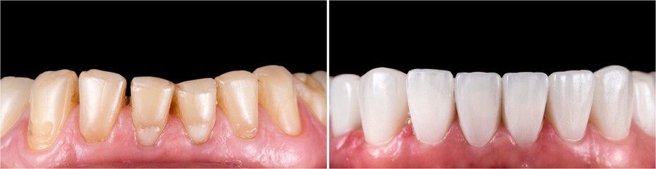 Fototapeta na wymiar teeth indirect restoration and making new smile by ceramic veneers b1 color