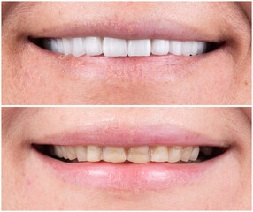 teeth indirect restoration and making new smile by ceramic veneers b1 color
