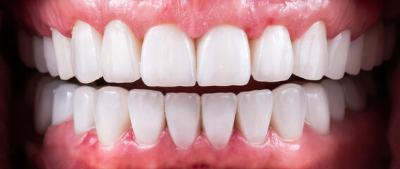 teeth indirect restoration by ceramic crowns and veneers