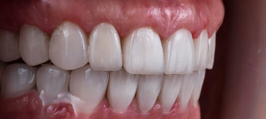 teeth indirect restoration by ceramic crowns and veneers