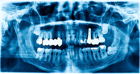 Panoramic radiograph dental X-Ray of a Caucasian male. Panoramic X-Ray of a mouth with dental implant, wisdom teeth and dental fillings. Concept of dental treatment and prevention.