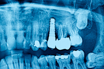 Radiograph dental X-Ray of a Caucasian male with dental implant. Concept of dental implantology - obrazy, fototapety, plakaty