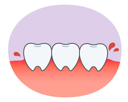 歯肉炎 Images Browse 1 486 Stock Photos Vectors And Video Adobe Stock