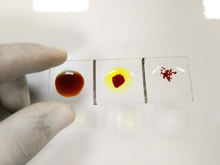 Medical Technologist hold blood sample for ABO blood grouping and Rh typing