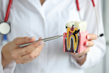 Doctor showing carious cavity with ballpoint pen on plastic artificial tooth model closeup