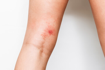 A red rash on the female thigh above the knee caused by an insect bite, allergy or an inflammatory process in the body. Eczema, atopic dermatitis, lichen, allergy, itching, urticaria, psoriasis