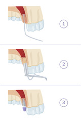Dental treatment. Closed sinus lift. Dental services. Vector illustration for dental textbooks