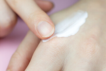 Woman applying hands cream. Irritated, problem skin of hands. Dermatology concept. Close up.