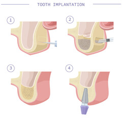 Dental treatment. Open sinus lift. Dental services. Vector illustration for dental textbooks. Step-by-step instruction