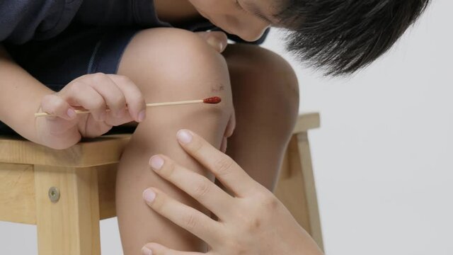 Kid apply cotton wool swab soaked with Povidone iodine for do basic first aid to the wound on the leg.