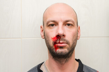 The guy is bleeding from his nose. Blood on the face of an unshaven man. Portrait of a man with a...