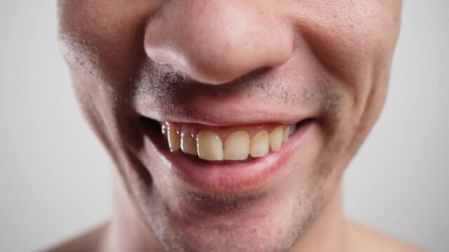 Close-up, a Man Smiles and Shows his Crooked Yellow and Unhealthy Teeth. Dental Care Concept. 