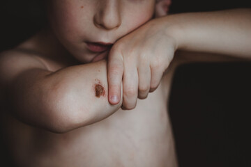 A boy holding on to a broken elbow