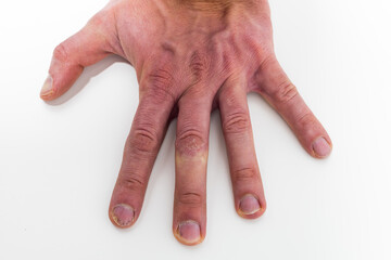 Hand with Psoriatic onychodystrophy or psoriatic nails. psoriasis unguium