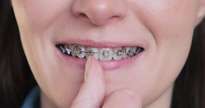Close-up smiling woman closing self-ligating braces. Work, fixing dental self-ligating braces in mouth. Adult beautiful female teeth smile in metal braces, cropped face. Orthodontic dentist treatment