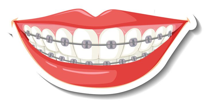 Teeth with braces on white background