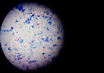 Sputum smear AFB stain microscopic close view. Macrobacterium Tuberculosis bacteria. Copy space