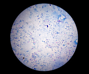 Sputum smear AFB stain microscopic close view. Macrobacterium Tuberculosis bacteria