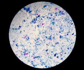 Sputum smear AFB stain microscopic close view. Macrobacterium Tuberculosis bacteria.