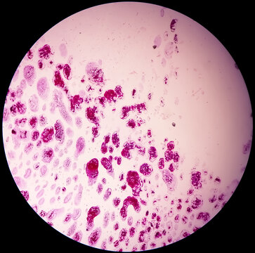 Gram staining, also known as Gram's method, is a method of differentiating bacterial species into two large groups (Gram-positive and Gram-negative). Here, Occasinal gram positive cocci are seen. 10X