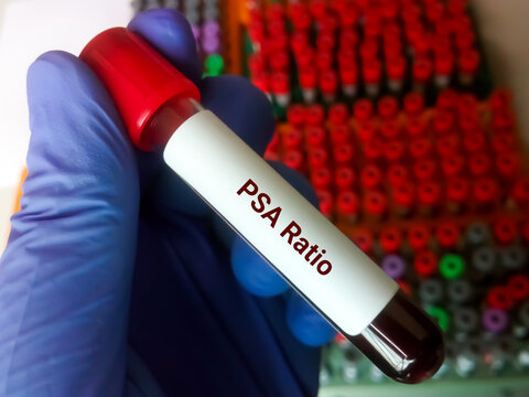 Biochemist hold test tube with blood sample for PSA Ratio test. Prostate specific antigen, diagnosis of prostate cancer