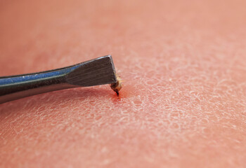 tweezers extract bee sting with insect venom from human skin