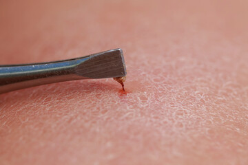 tweezers extract bee sting with insect venom from human skin
