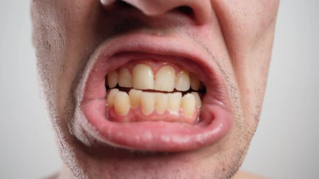 Close-up, a Man Shows his Crooked Yellow and Unhealthy Teeth. Dental Care Concept. 