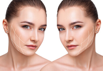 Young beautiful woman with lifting lines before and after chin correction.