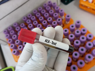 Lab Technician hold blood sample for ACA (Anti Cardiolipin Antibodies) test, diagnosis of...