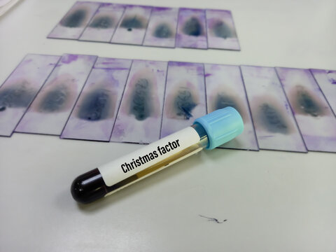 Blood Sample For Christmas Factor Or Factor IX Test. Blood Coagulation Testing. Antihemophilic Factor B, Christmas Disease, Factor IX Hemophilia