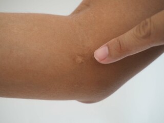A scar on a man arm, pointing at the scar. closeup photo, blurred.